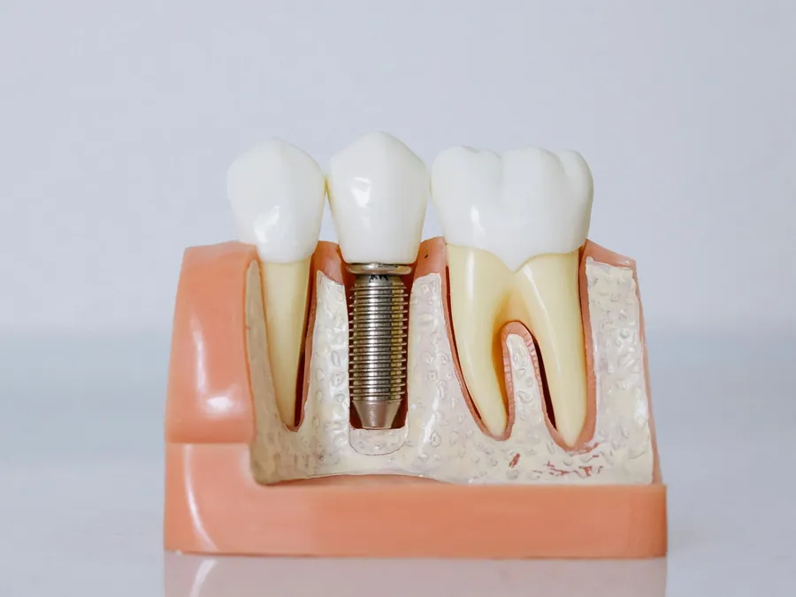 Modèle d'implant dentaire avec couronne dans la mâchoire